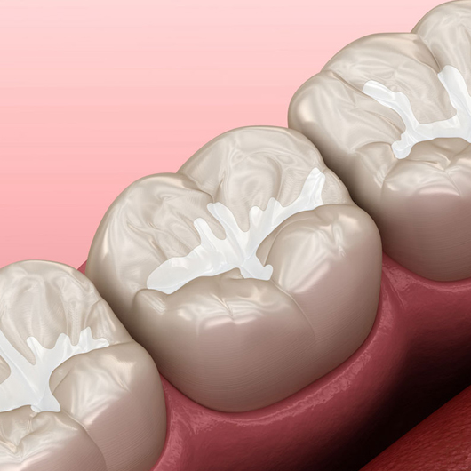 Three dental crowns on pink gum model showing pediatric dental restoration treatment.